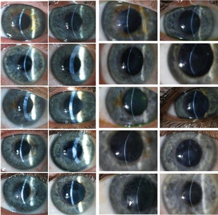 Bioengineered Cornea Are About To Enter The Clinical Realm