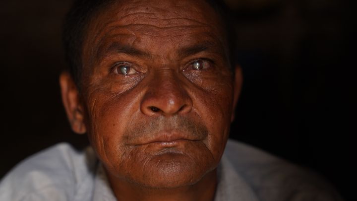 A close up photo of a male patient with cataracts in a dark room